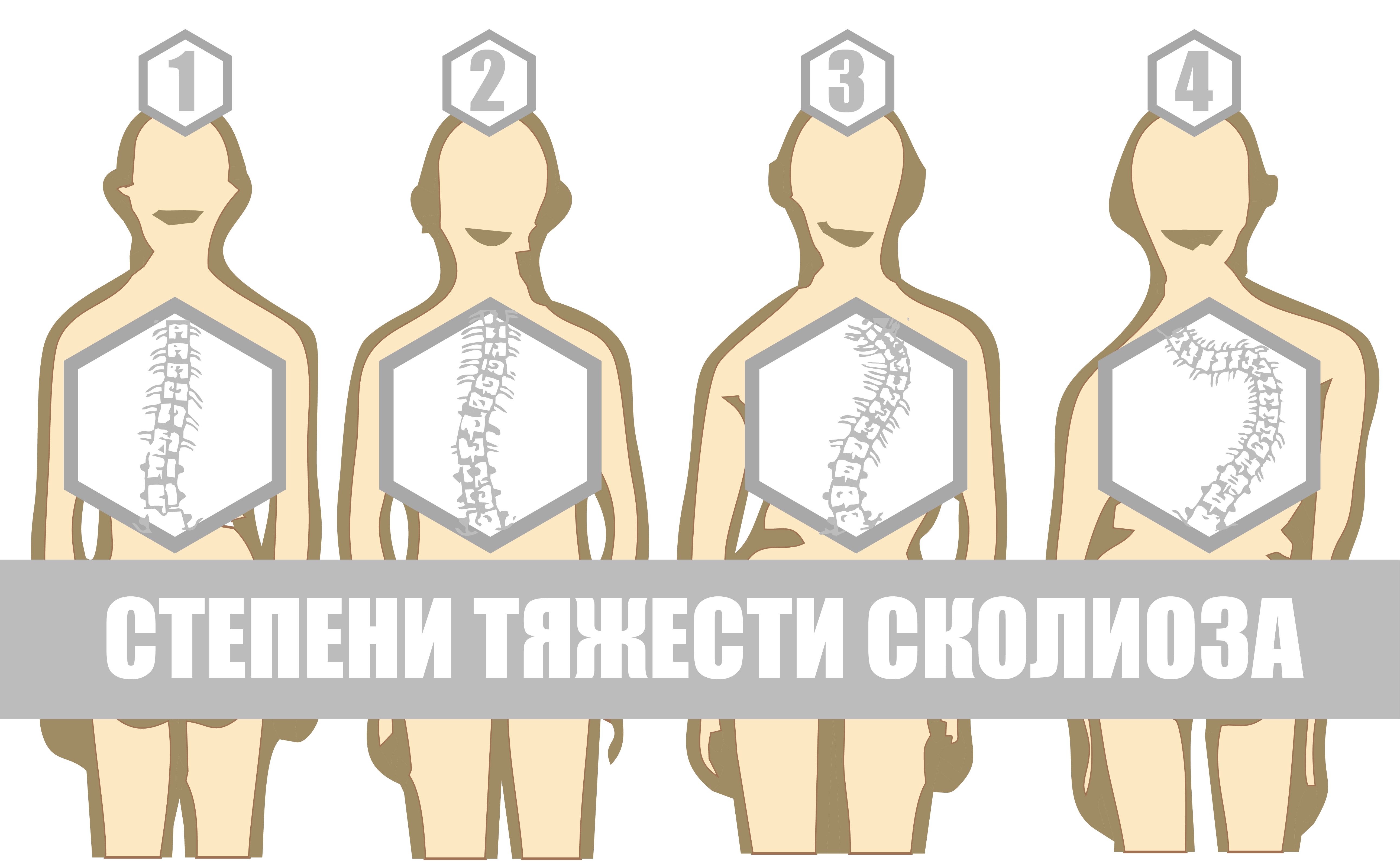 Сколиоз у детей: как предотвратить и можно ли вылечить? — МЦ Здоровые дети  Секреты долголетия